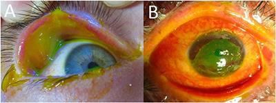 USA: Ophthalmologic Evaluation and Management of Acute Stevens-Johnson Syndrome